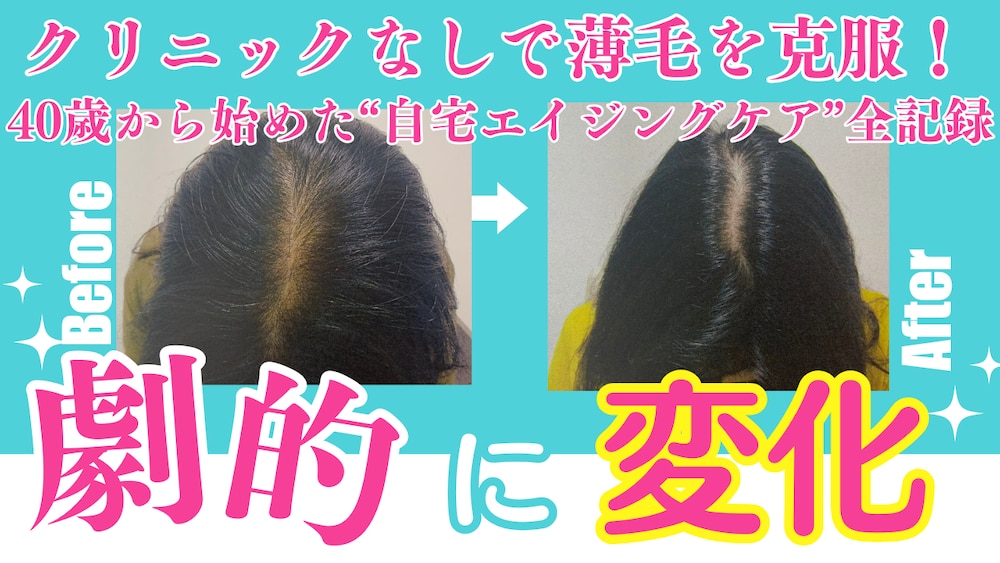 クリニックなしで薄毛を克服！40歳から始めた“自宅エイジングケア”全記録